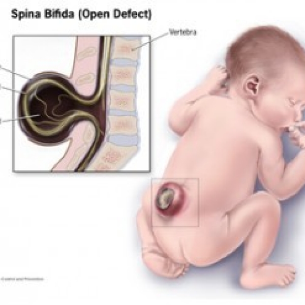 Graphic describing spina bifida